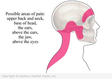 Tension headaches can have many causes and different presentations