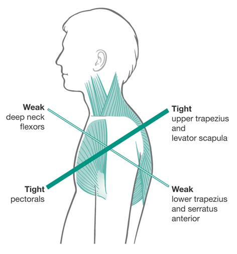 upper crossed syndrome, with impaired posture and imbalance
