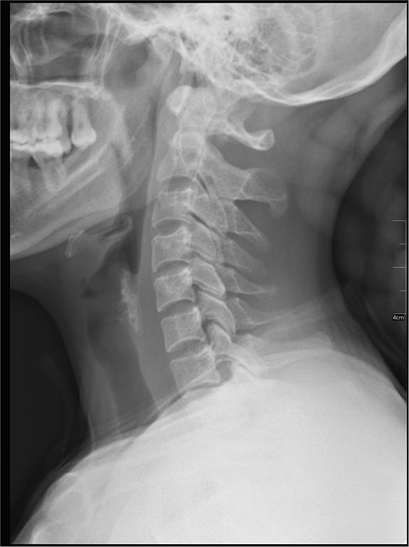 cervical spine xray, lordosis