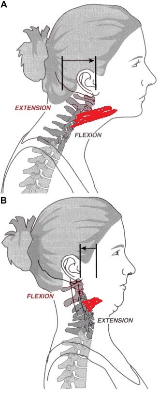 When our head is forward, the curves in our upper and lower neck are opposite what they should be. It also causes our deep neck flexors to be stretched and weakened (vs. activated and strong like when our head sits on top of the shoulders properly).