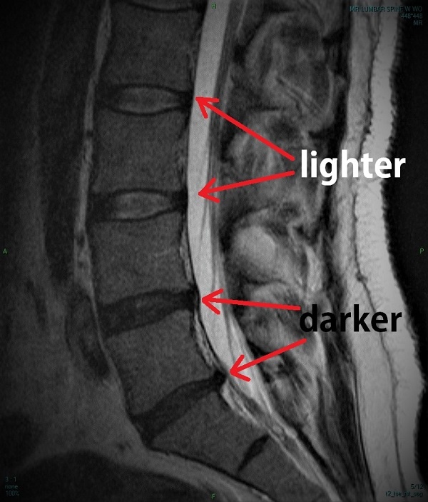 Lower spine MRI, showing dehydration of disc (darker means less water)